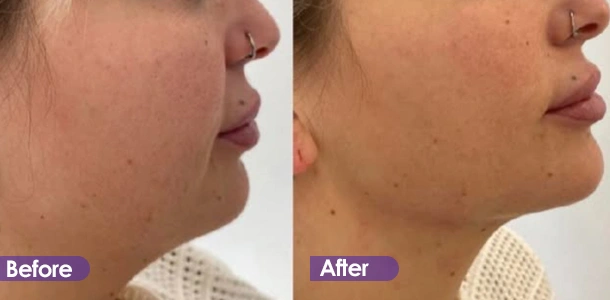 Jawline tightening treatment result