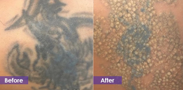 Large tattoo removal before and after