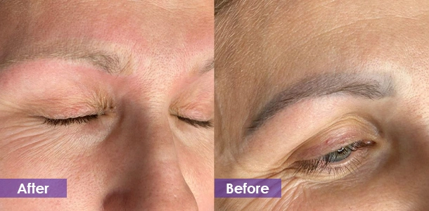 Nd: Yag Eyebrow Tattoo Removal