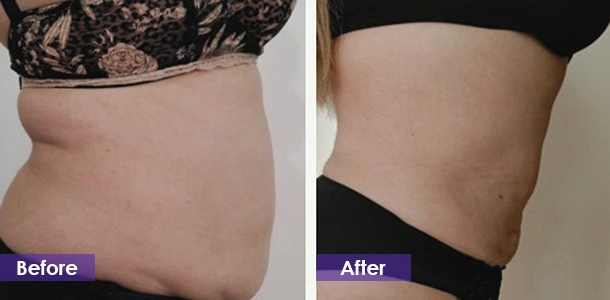 Abdominal fat reduction before and after