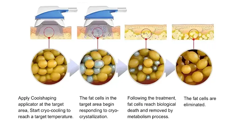 How does 360 Cryolipolysis work?