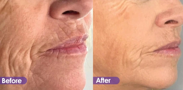 HIFU Lip tightening before and after