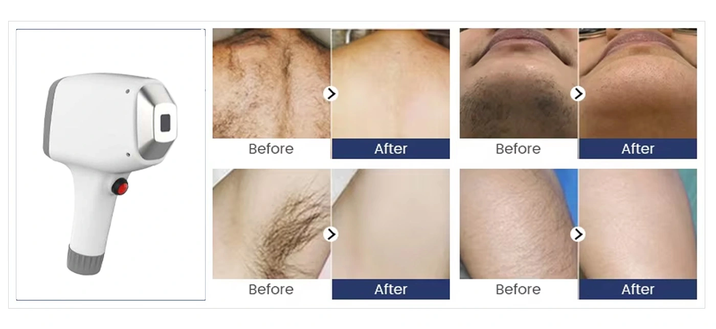 Before and after hair removal photos