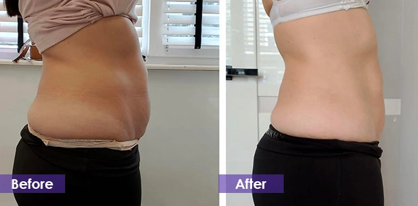 EMS-скульптурирование Abdominal Firming before and after