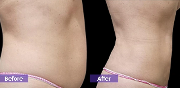 Abdominal fat reduction before and after