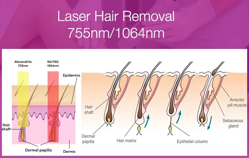 755nm Alexandrite laser machine Working Principle