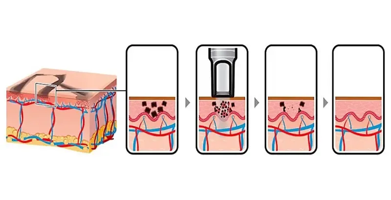 How Pico Laser Technology Works
