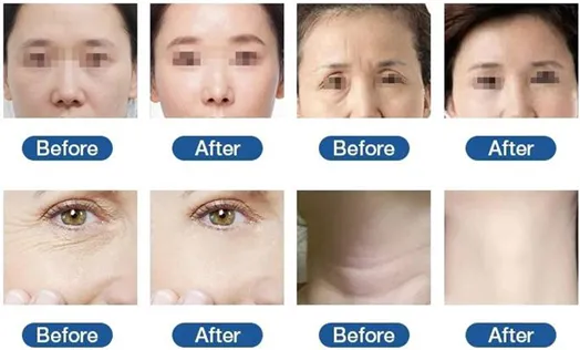 Multi-Functional HIFU Device Before and After