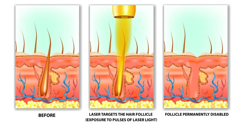 How Diode Laser work？