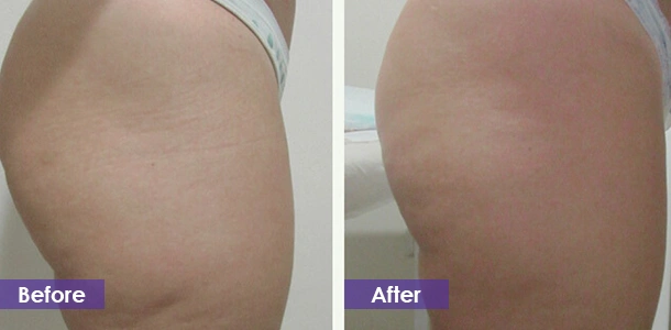 EMS Buttock Sculpting before and after