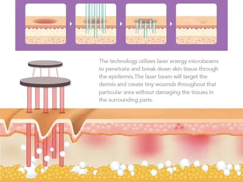 CO2 lasers Working Principle