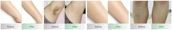 Hair Removal Treatment