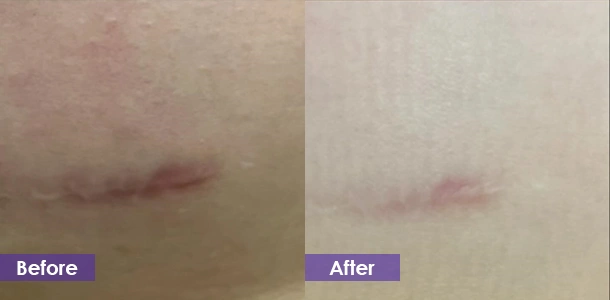 fractional RF microneedling Scar Removal before and after