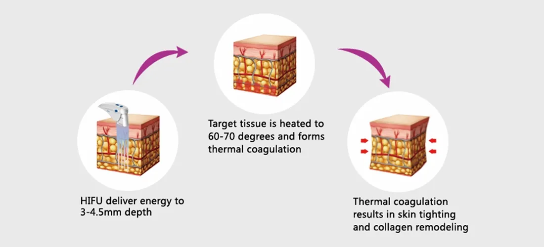 How HIFU Treatment Works