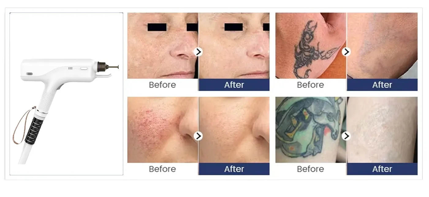 nd yag laser tattoo removal before and after