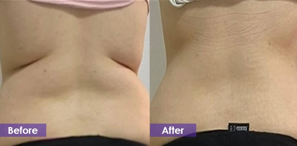 Waist fat dissolving before and after