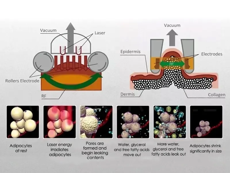 How does vacuum RF body contouring work?