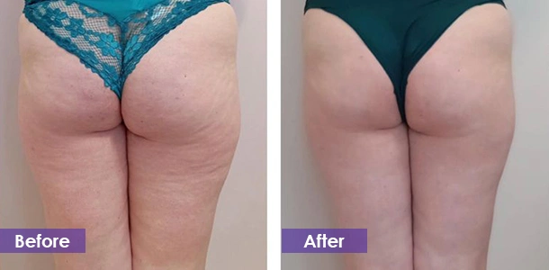 Buttocks fat reduction before and after