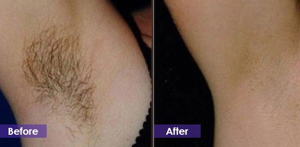 arm hair removal