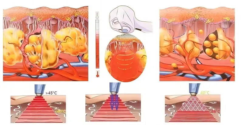 How does the RF body contouring work?