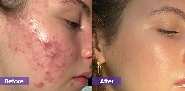 Microneedle Fractional RF Acne treatment before and after