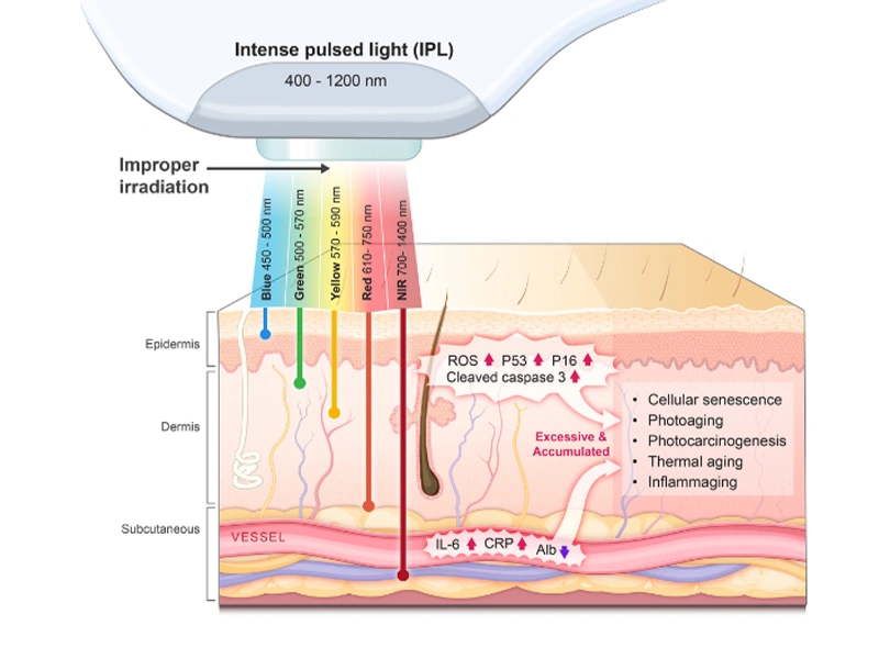 How Intense pulsed light (IPL) work?
