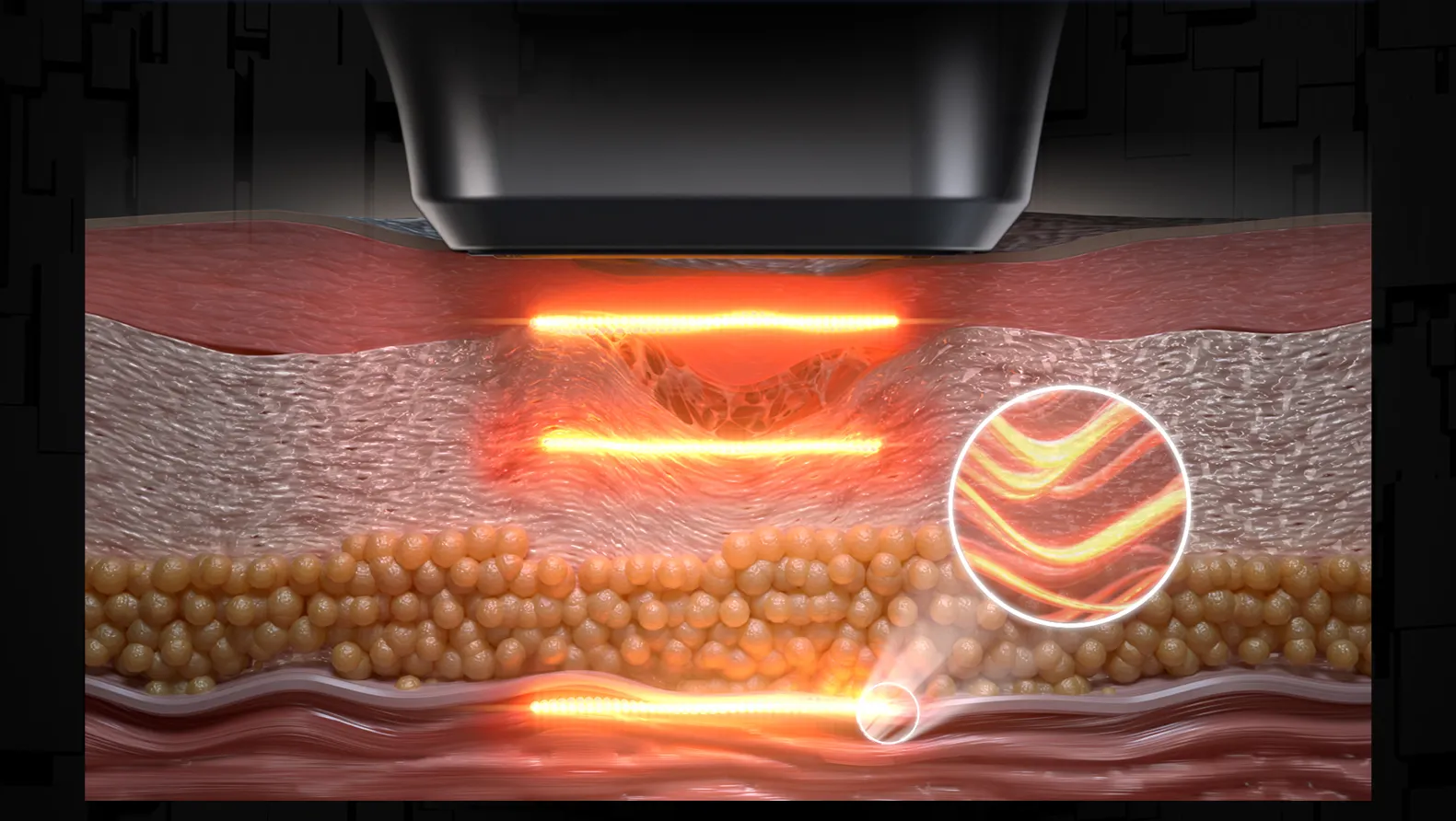ULTRA MICRO PULSE ULTRASONIC SYSTEM