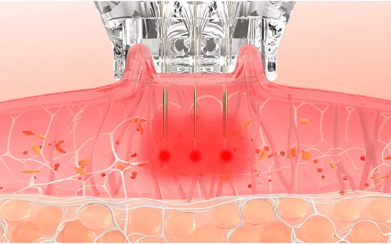 Microneedle Vacuum Adsorption