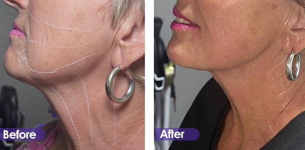Facial firming before and after