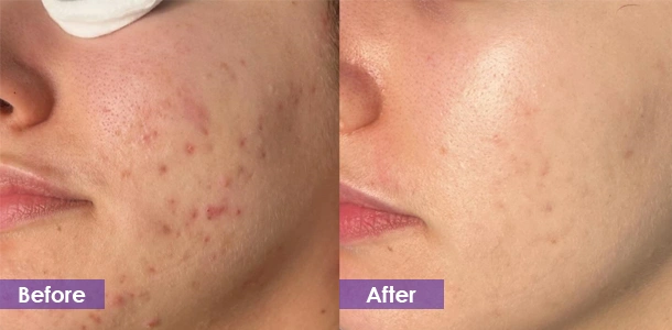 Microneedle Fractional RF Lighten acne scars before and after