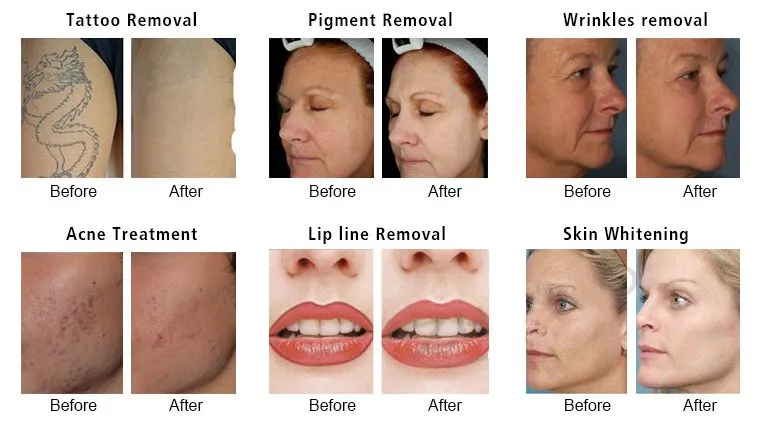 laser tattoo removal before and after