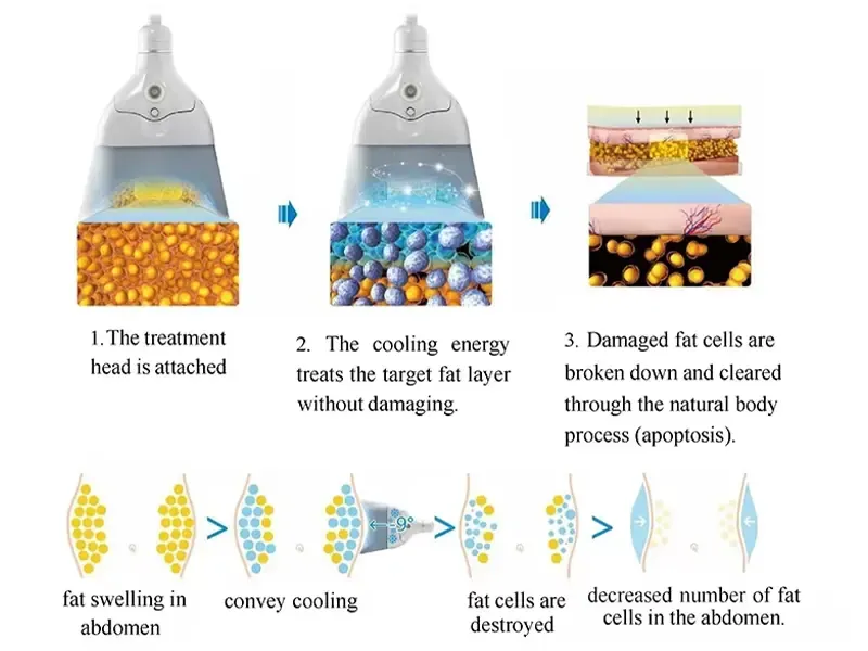 How the EMS & Cryolipolysis Machine Works