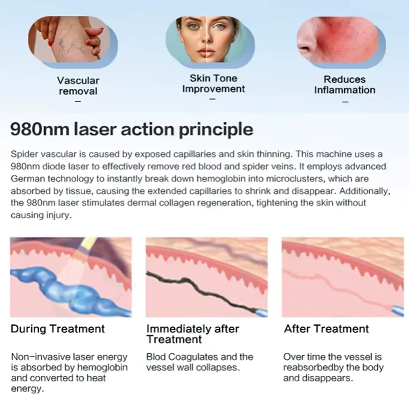 980nm laser action principle