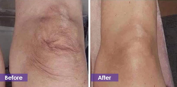ght legs before and after