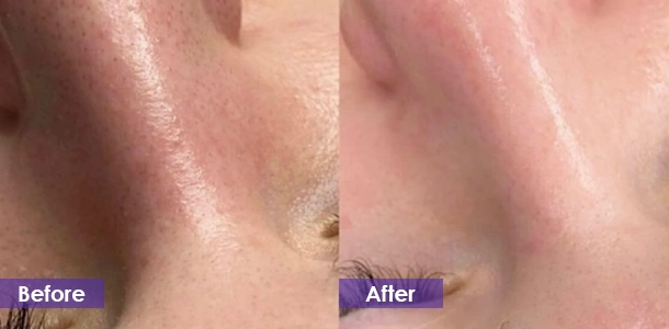 Clean pores before and after