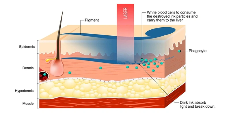 How Q-switched Nd:YAG laser work？