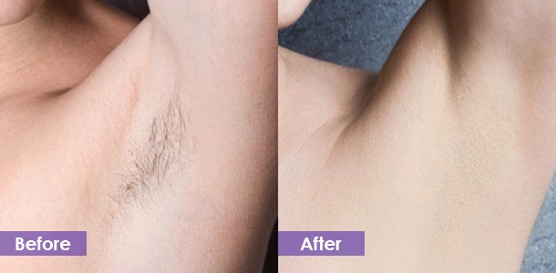 laser hair removal before and after
