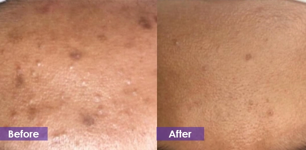 CO2 laser acne scar removal treatment result