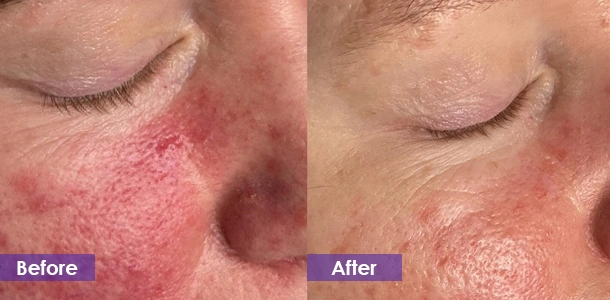 Reduce facial redness