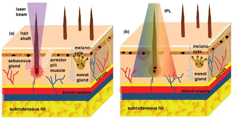 What is IPL Hair Removal?