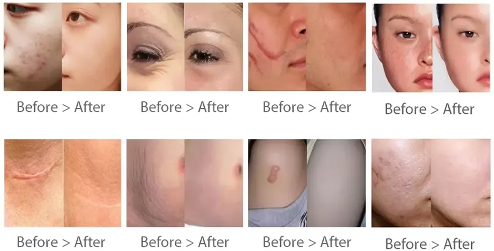 dual-wavelength laser 4D Scar removal before and after
