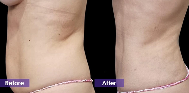 Abdominal fat reduction before and after