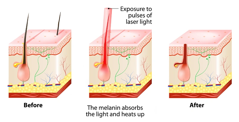 diode laser how it work