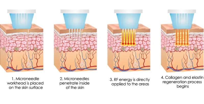 How does the Microneedle Fractional Radiofrequency Skin Anti-Aging System work?
