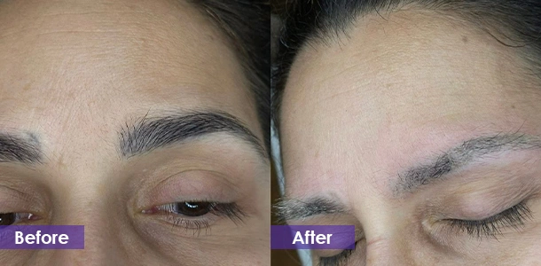 Eyebrow Tattoo Removal before and after
