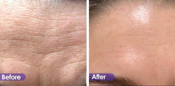 Forehead wrinkle removal and firming