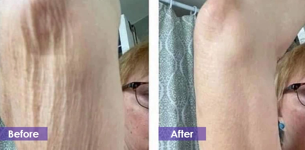 Arm fat reduction before and after