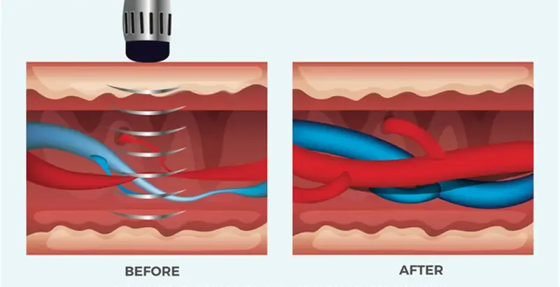 How Shockwave works？