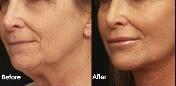 Lip wrinkle removal and firming before and after