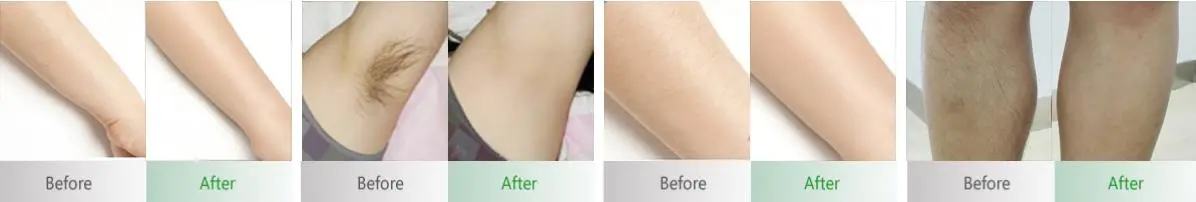 Diode laser Hair Removal before and after